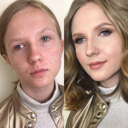 Акне и макияж к проблемной коже