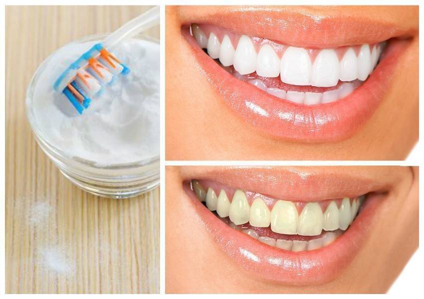 Гигиеническая чистка зубов: примеры, советы профессионалов