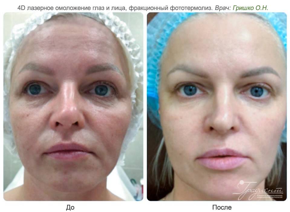 Биоревитализация лица – что это за процедура: эффект «до и после», противопоказания к гиалуроновой кислоте в косметологии, как часто можно делать ревитализацию кожи и что она дает – плюсы и минусы
