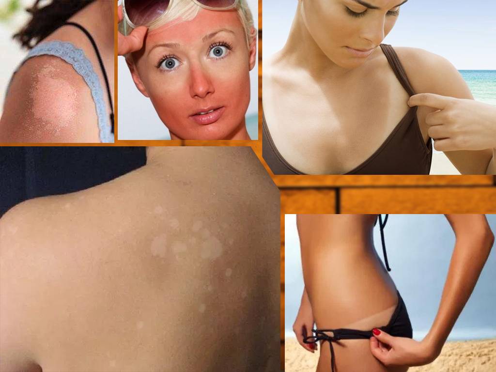 Что делать при солнечном ожоге кожи: рекомендации и обзор 6 косметических средств