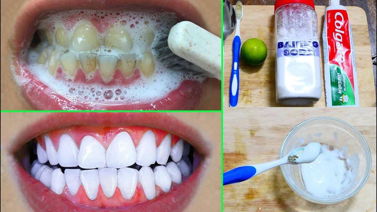 Гигиеническая чистка зубов: примеры, советы профессионалов.