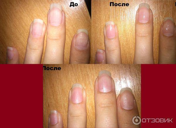 Как восстановить ногти после наращивания в домашних условиях: быстрые средства