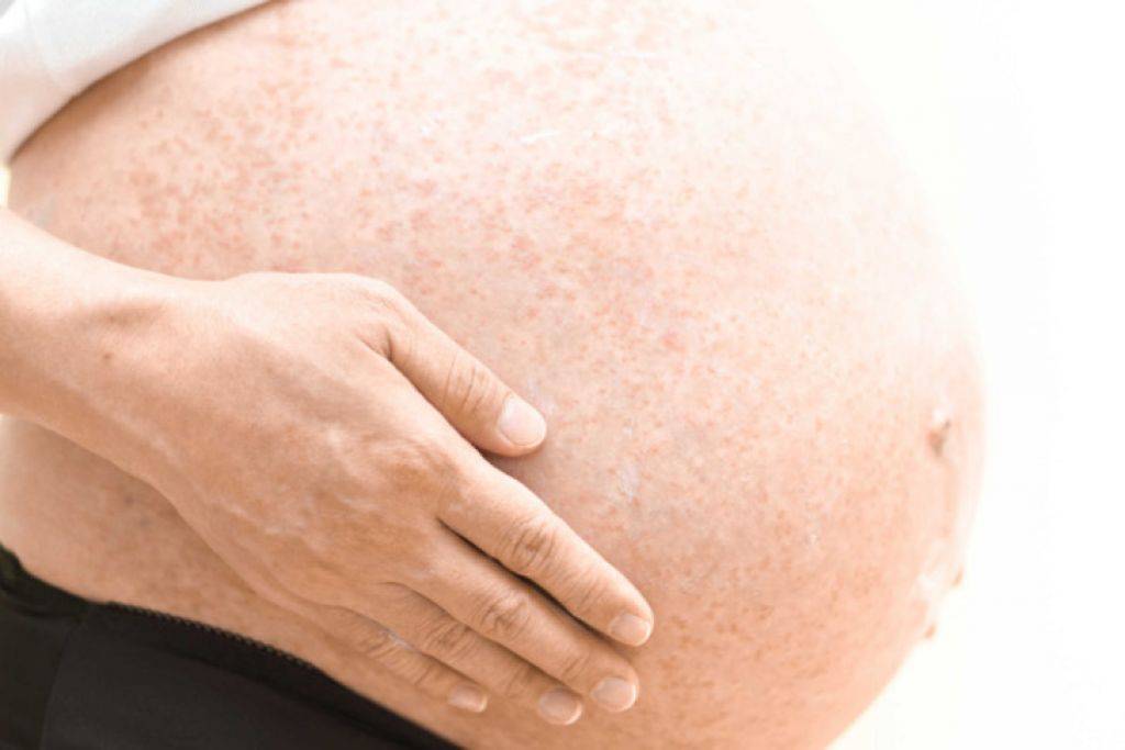 Методы лечения акне у беременных | портал 1nep.ru