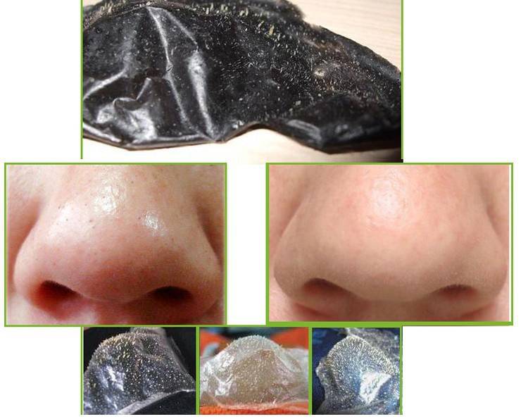 10 топ масок с активированным углем и желатином от черных точек (рецепты) на лице и носу