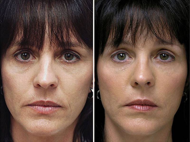 Биоармирование лица гиалуроновой кислотой фото до и после