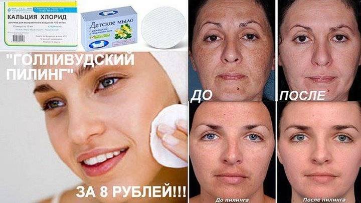 Чистка кожи лица: пилинг хлоридом кальция