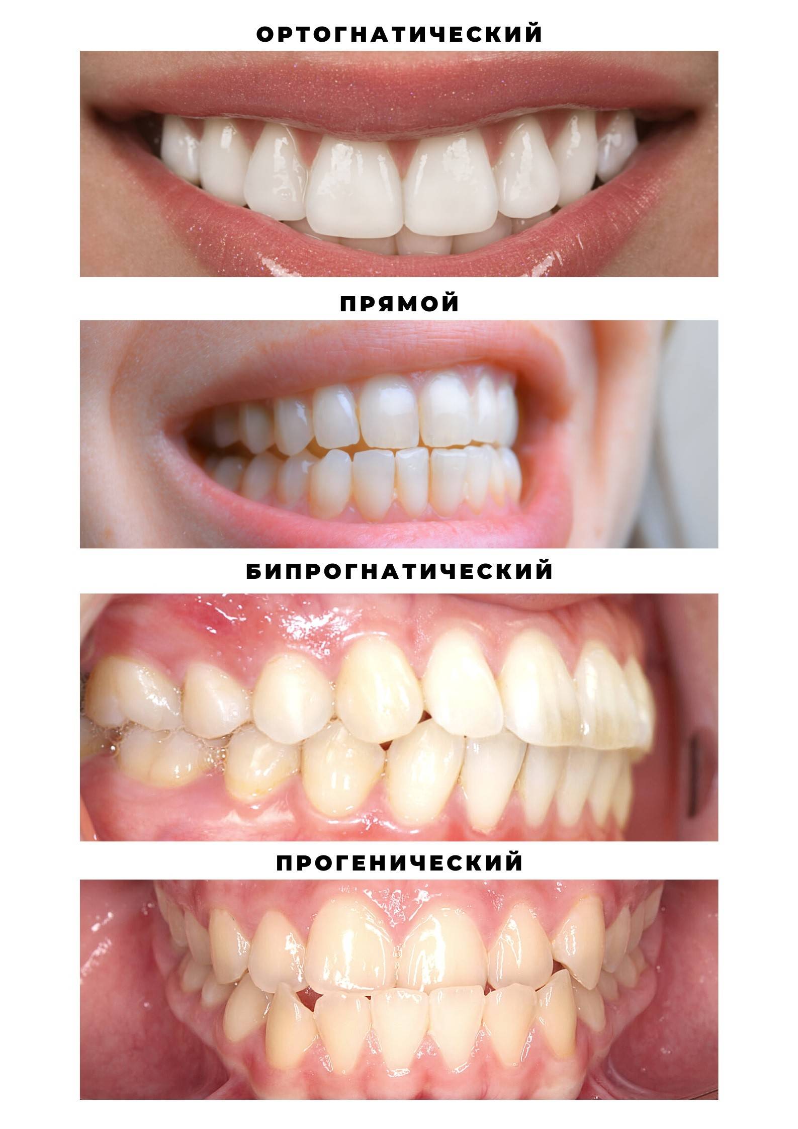 Как определить и исправить неправильный прикус зубов – статьи стоматологической клиники «доктор мартин»