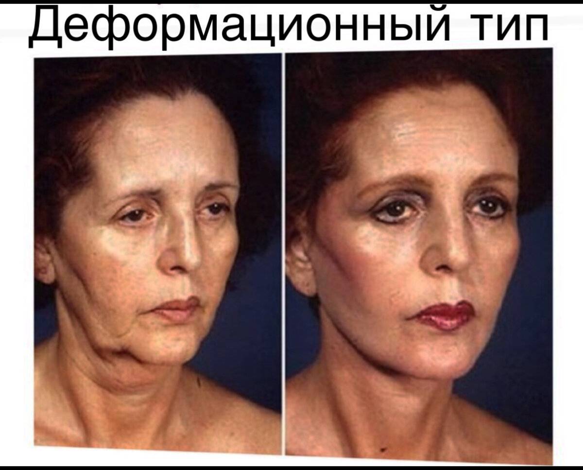 Невропатия лицевого нерва