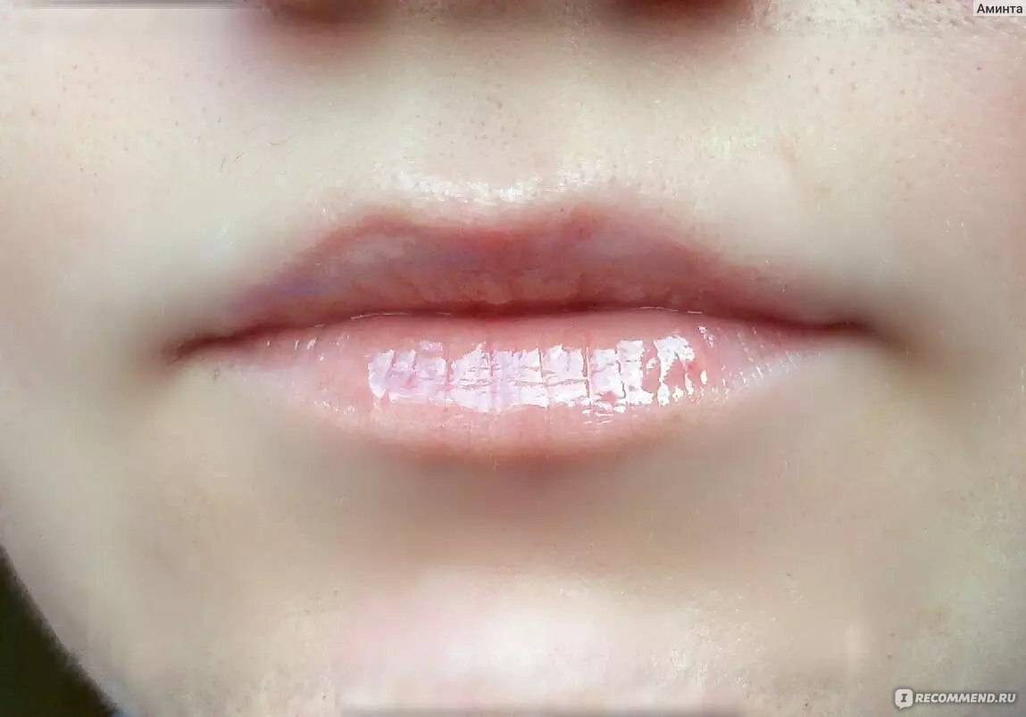 Сильно обветренные губы