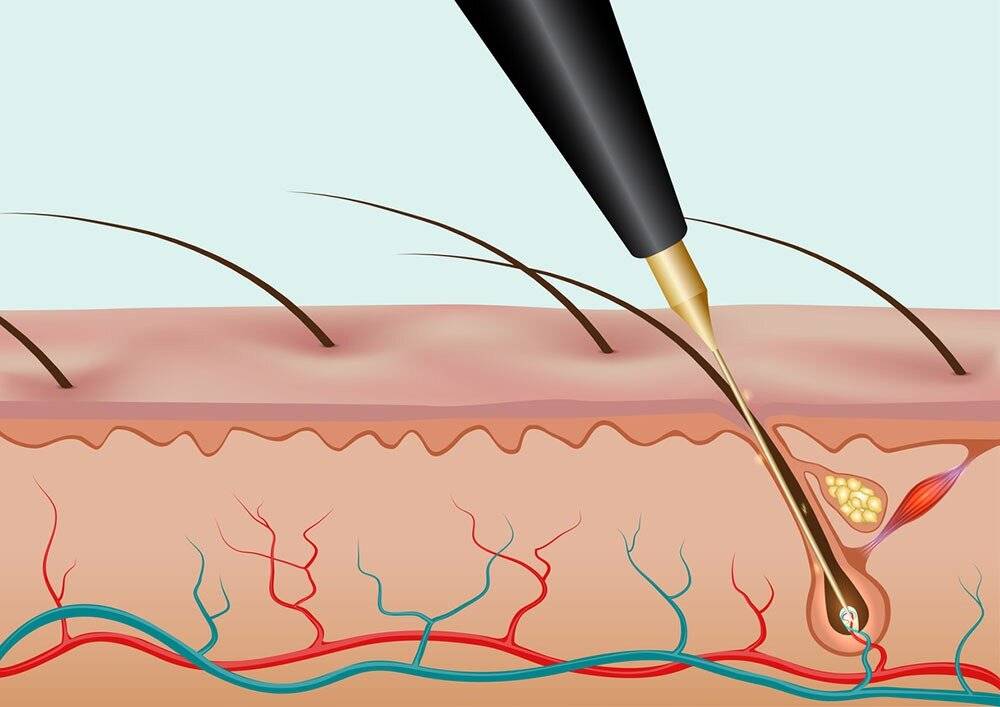 Электроэпиляция волос — что это такое, как сделать, противопоказания, последствия