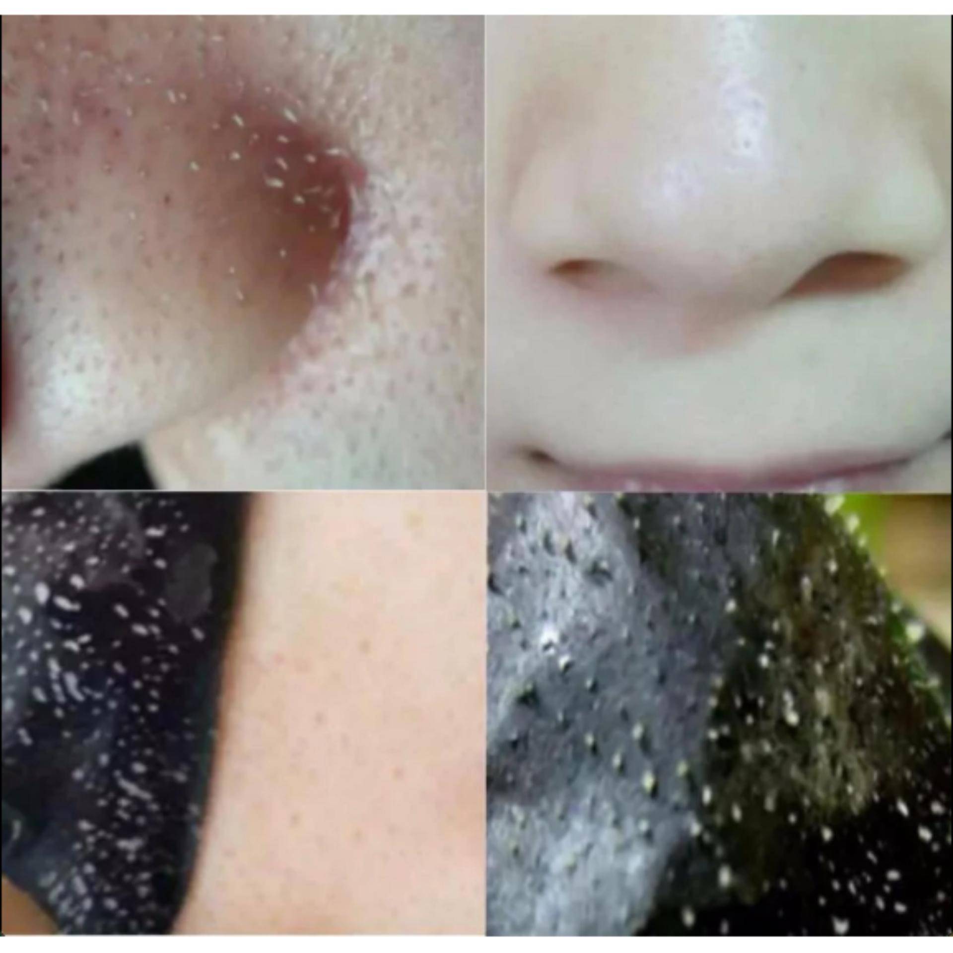 Топ-15 методов как избавиться от черных точек в домашних условиях на лице и носу, отзывы