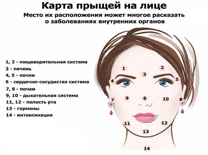 Прыщи, воспаления на лице причины по зонам - подробная информация