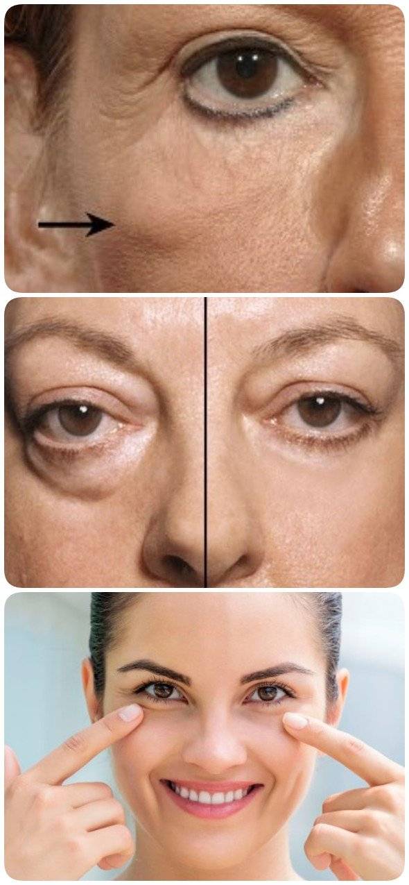 Как убрать морщины вокруг глаз: методы косметологии и пластической хирургии