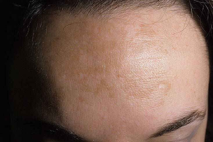 Меланома кожи: стадии, фото и процедура лечения. онкология