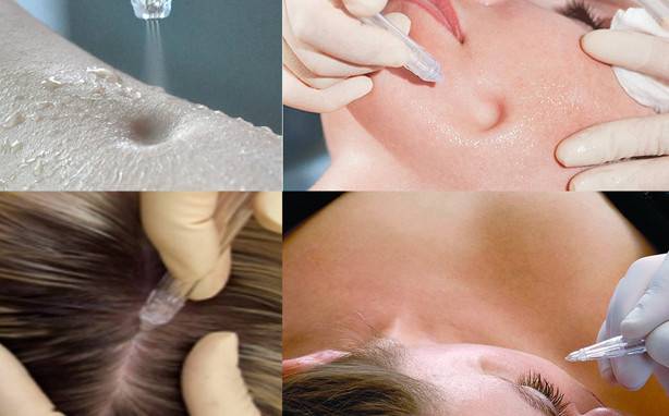 Хайдрафэшл (hydrafacial): калифорнийский массаж для кожи лица!