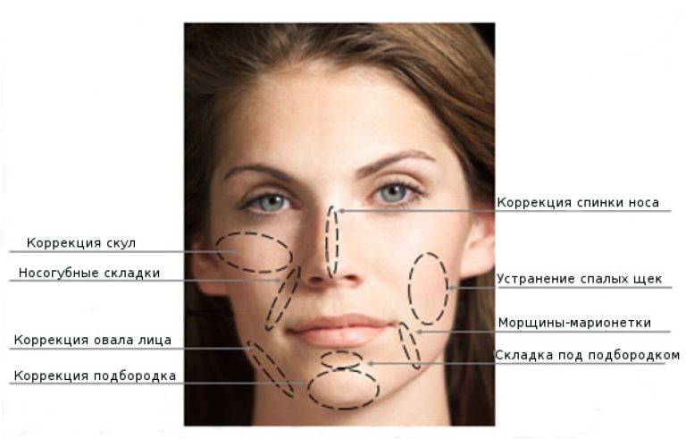 Липофилинг лица - что это такое, описание процедуры | клиника эстетической медицины expert clinics