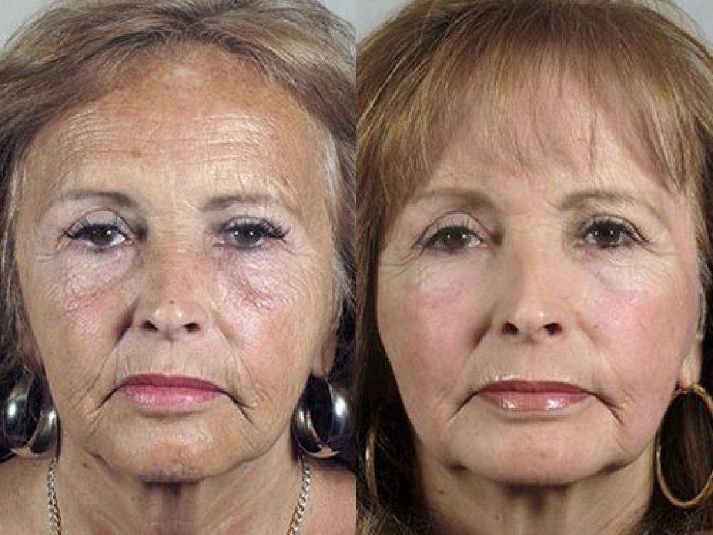 Процедуры для омоложения лица: самая эффективная, косметические, косметологические, лазерные