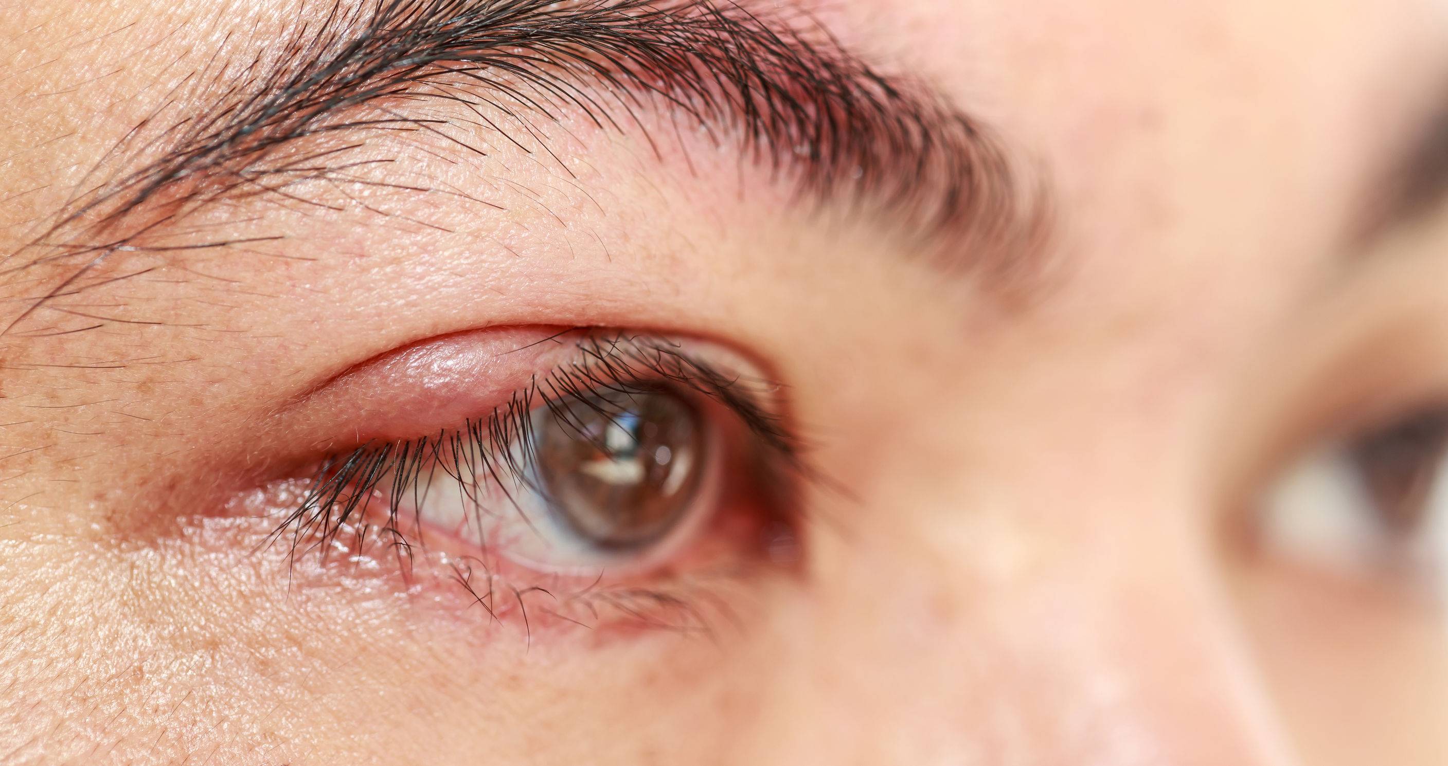 Лечение блефарита у взрослых и детей. анализ из глаза на возбудитель блефарита - медицинский центр «эхинацея»
