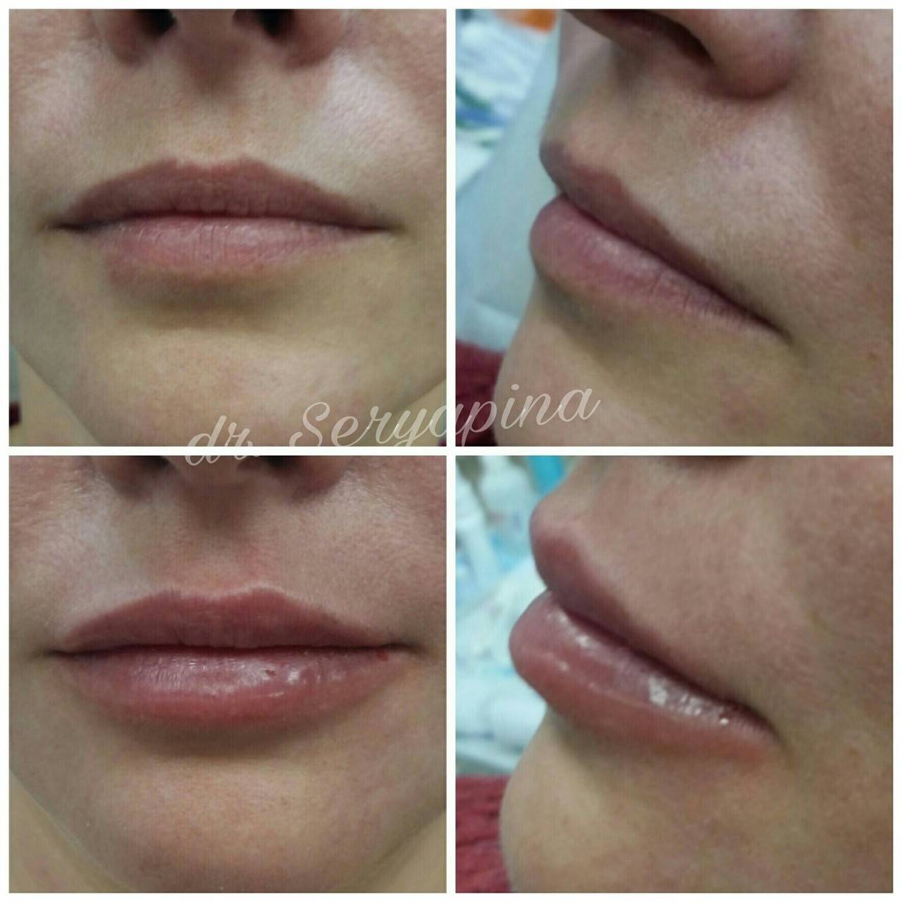 Хейлопластика (пластика губ), увеличение губ операцией | стоимость коррекции верхней и нижней губы