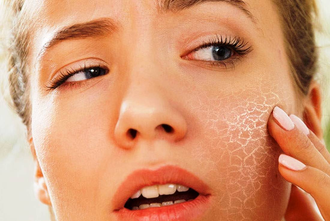 Почему возникает сухая кожа на лице и как от нее избавиться