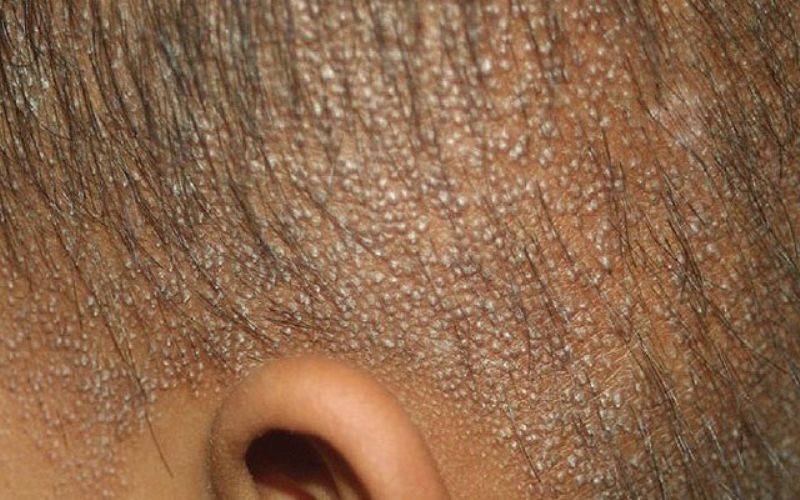 Актинический кератоз кожи: лечение, фото, код мкб-10 – эл клиника