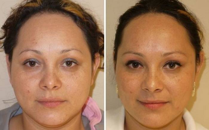 Что нужно знать об уколах ботокса в область лица и шеи - клиника косметологии