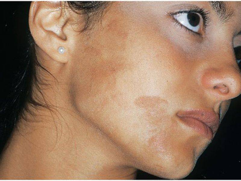 Гиперпигментация – причины и лечение, профилактика гиперпигментации кожи
