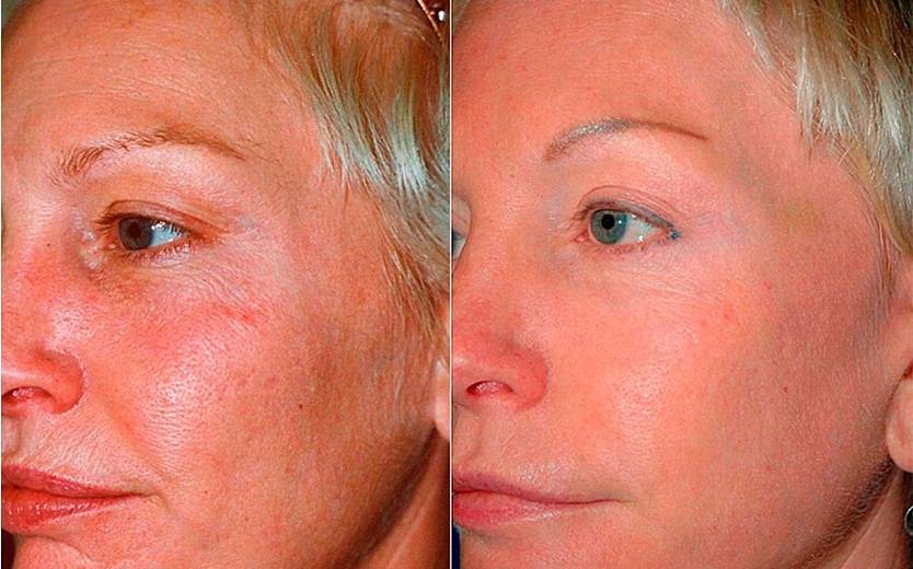 Фотоомоложение кожи лица лазером - что за процедура | клиника бионика (санкт-петербург)
