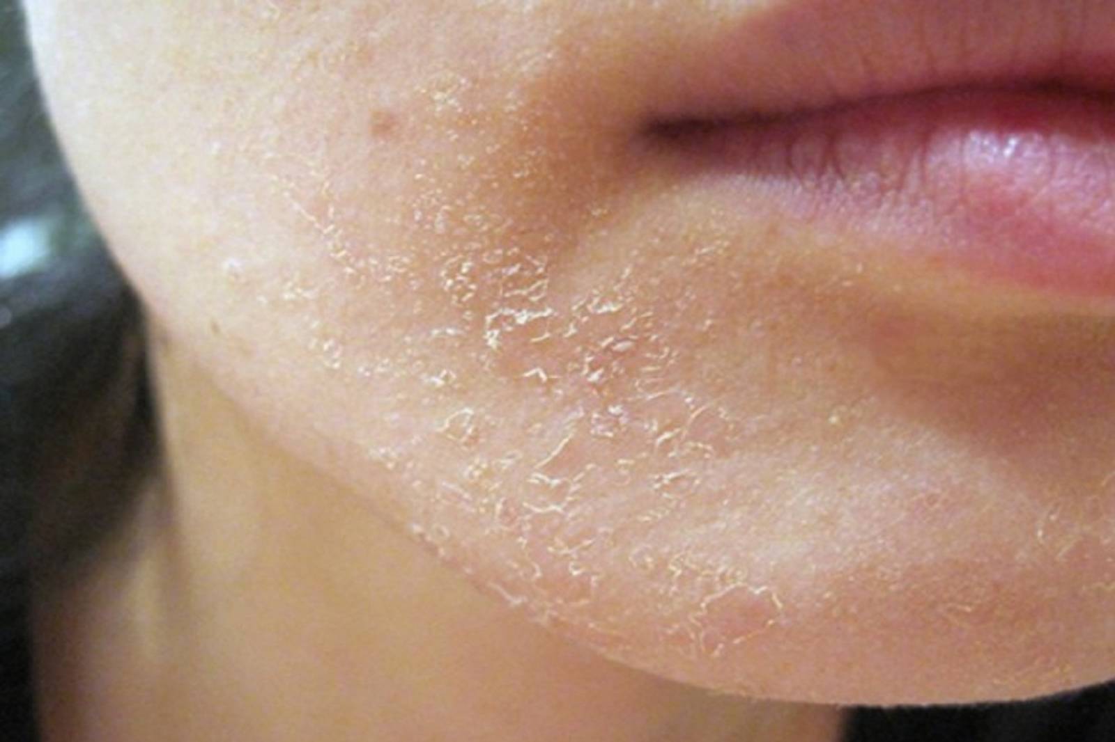Что делать, если кожа лица очень сухая и сильно шелушится?