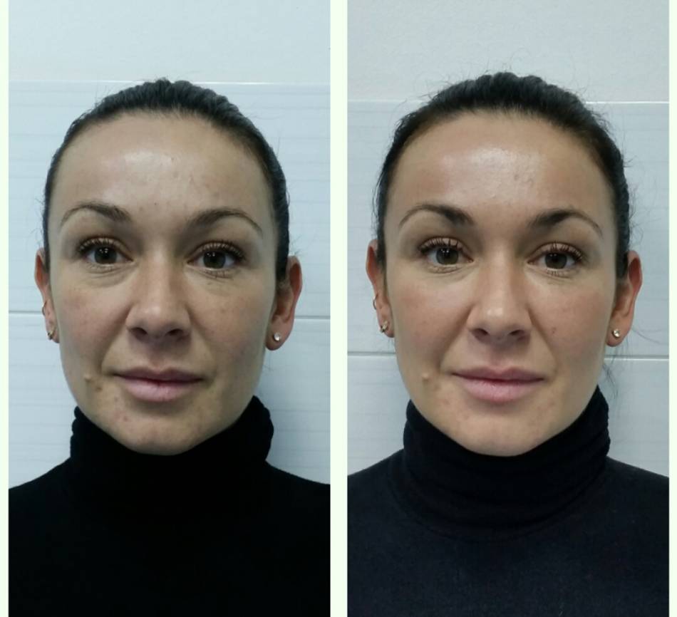 массаж лица скульптурный фото до и после