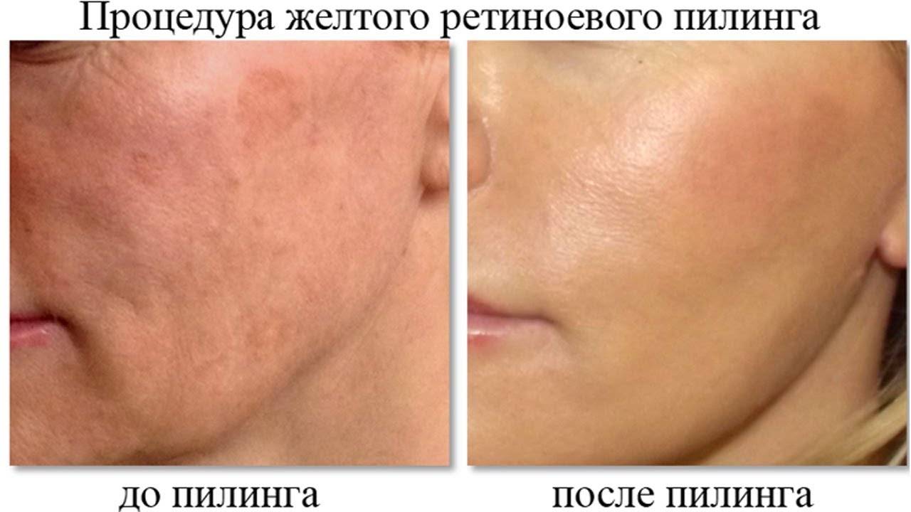 Разновидности химических пилингов