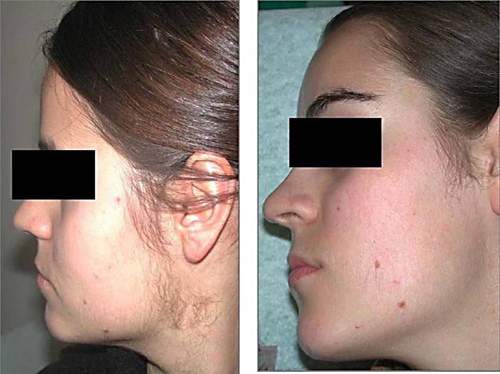 Волосы на лице у женщин: причины и лечение, как удалить навсегда