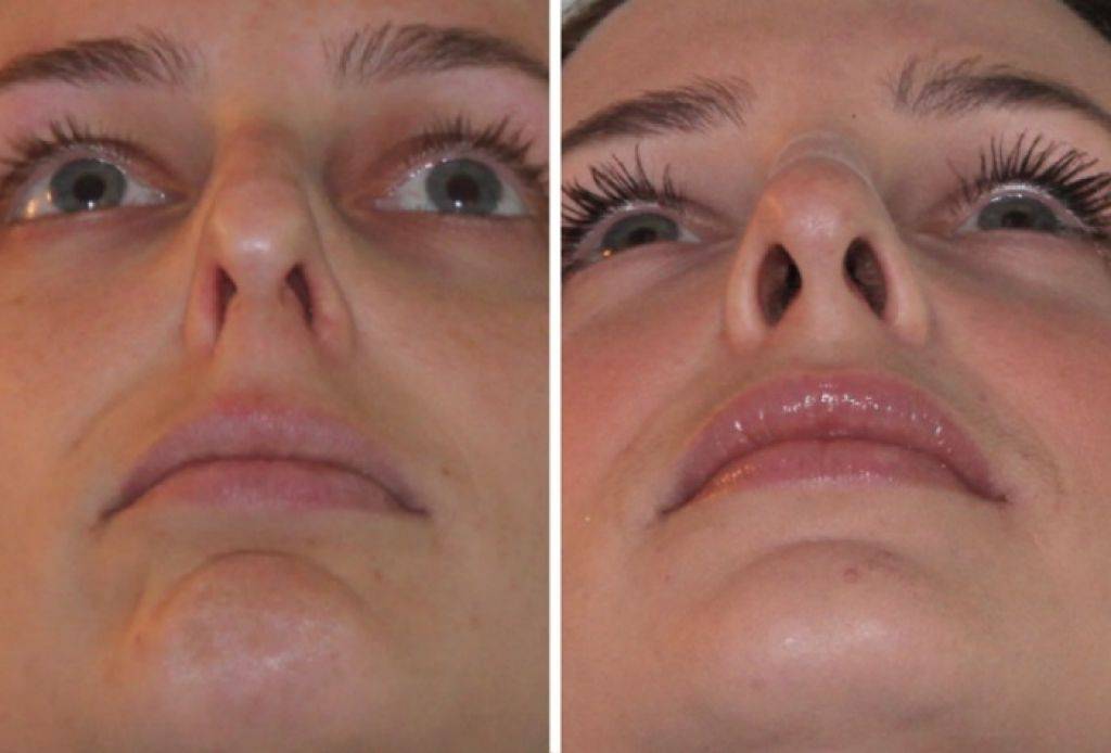 Септопластика носовой перегородки: эндоскопическая и лазерная