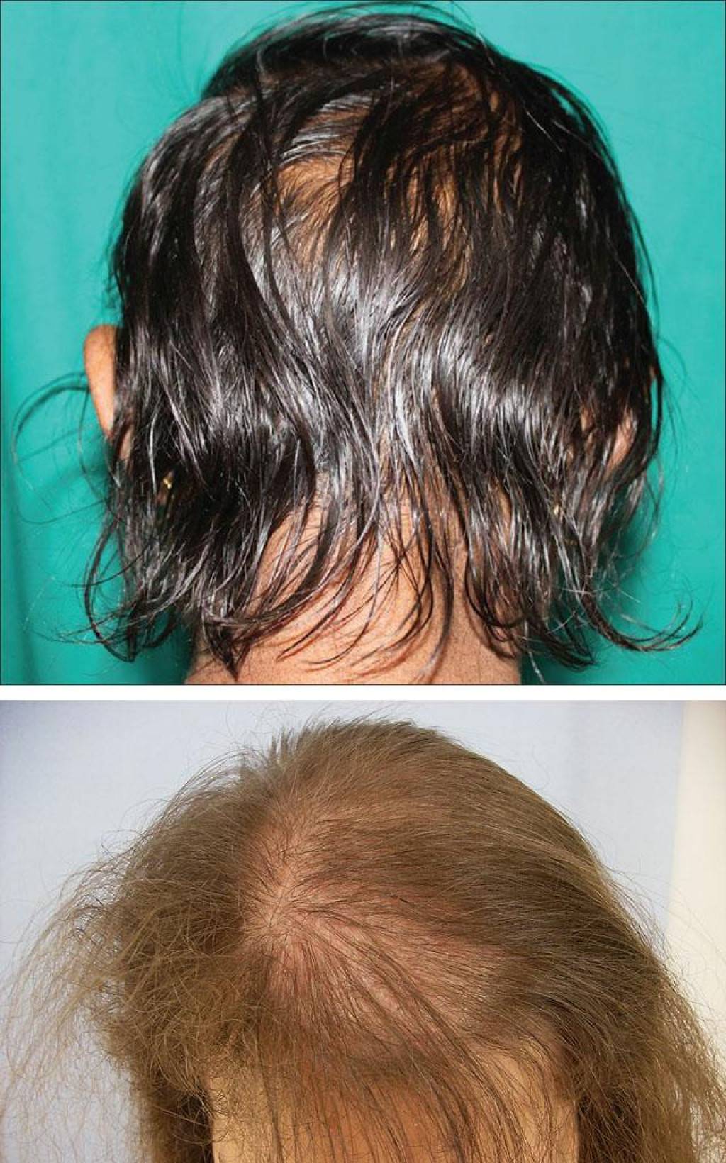 Почему с возрастом волосы истончаются и редеют у женщин