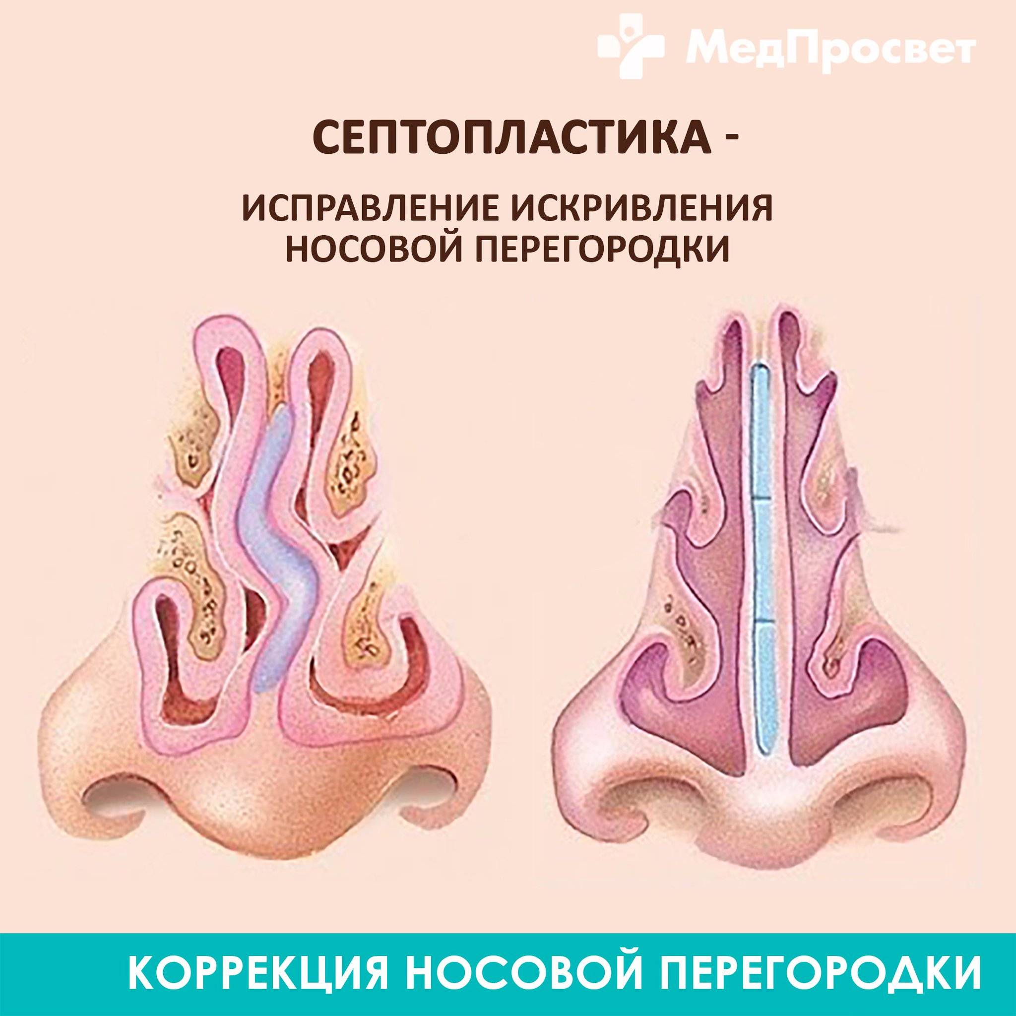 Септопластика носа — показания к операции на носовой перегородке | цэлт