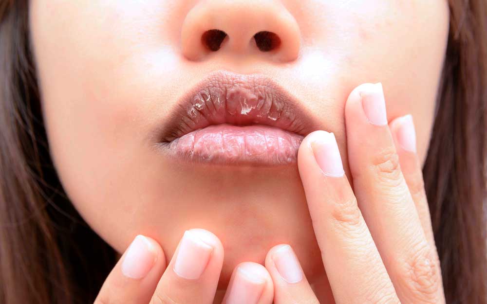 Причины возникновения трещины на половых губах? симптомы, диагностика, лечение