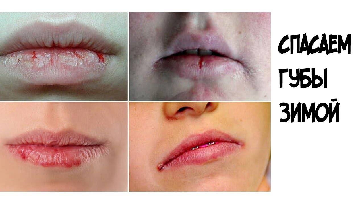 Причины появления трещин на губах и способы их лечения