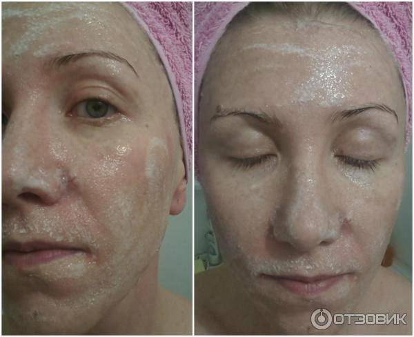 Постпилинговый уход за кожей лица: следуем рекомендациям косметолога, чтобы облегчить восстановительный период