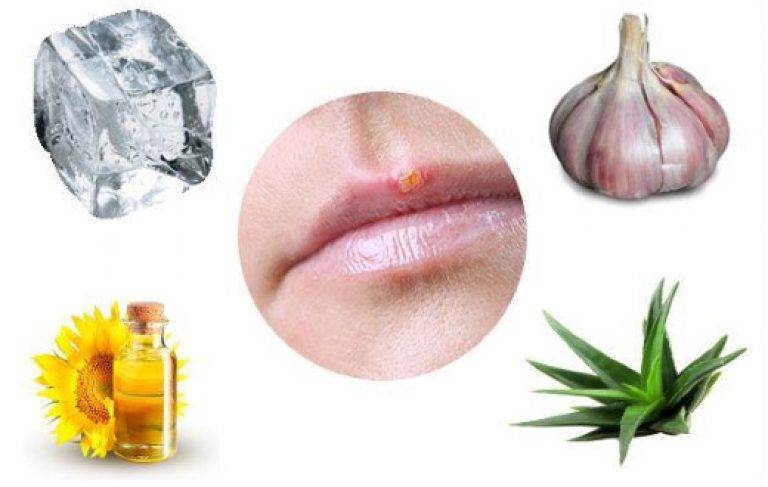 «простуда на губах»: как ухаживать за кожей