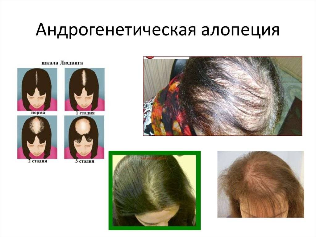 Выпадение волос: причины, симптомы, диагностика и лечение