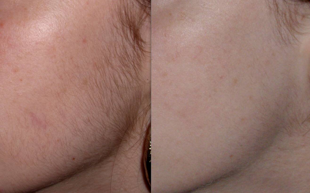 Удаление волос на лице у женщин с помощью лазера