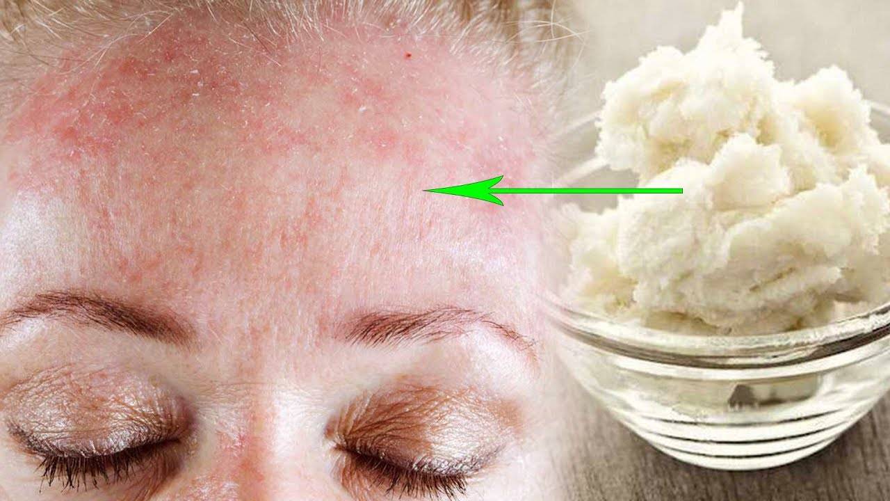 Шелушится кожа на лице [обзор средств] - причины появления и как убрать шелушение