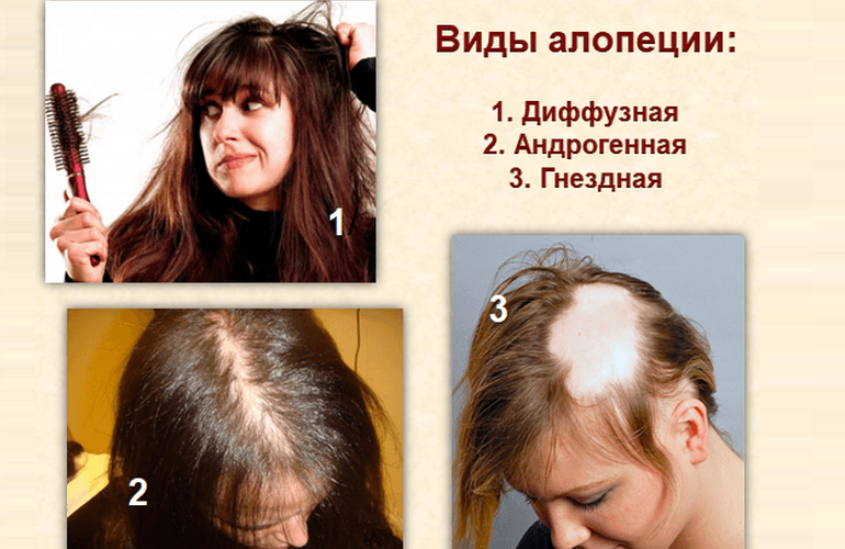 Диффузное выпадение волос * клиника диана в санкт-петербурге