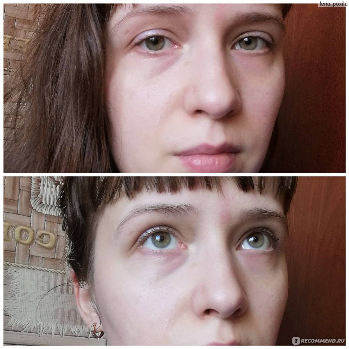 Как избавиться от темных кругов под глазами. до и после фото. - косметология доктора корчагиной