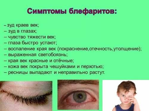 Блефарит: симптомы, фото, лечение блефарита глаза