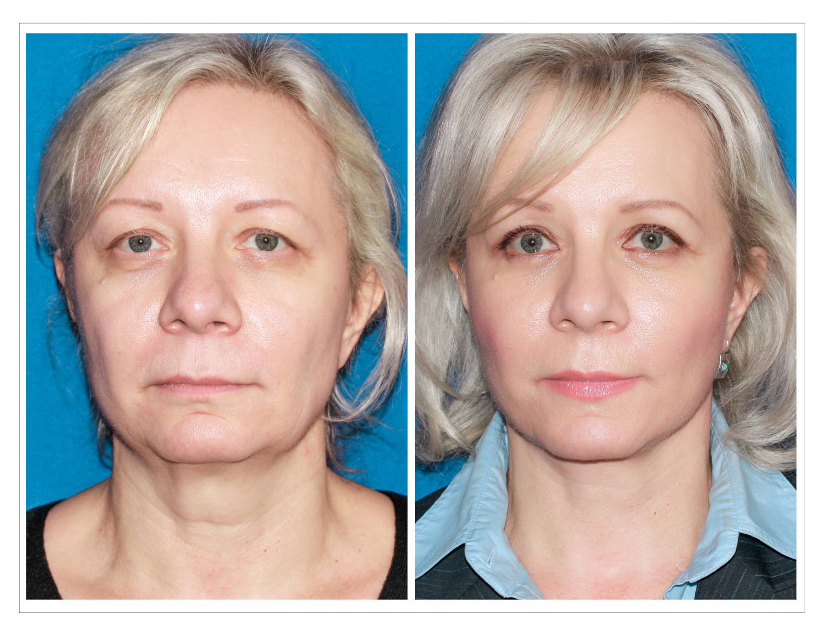 Тредлифтинг (3d нити) – подтяжка лица с помощью мезонитей последнего поколения - клиника косметологии