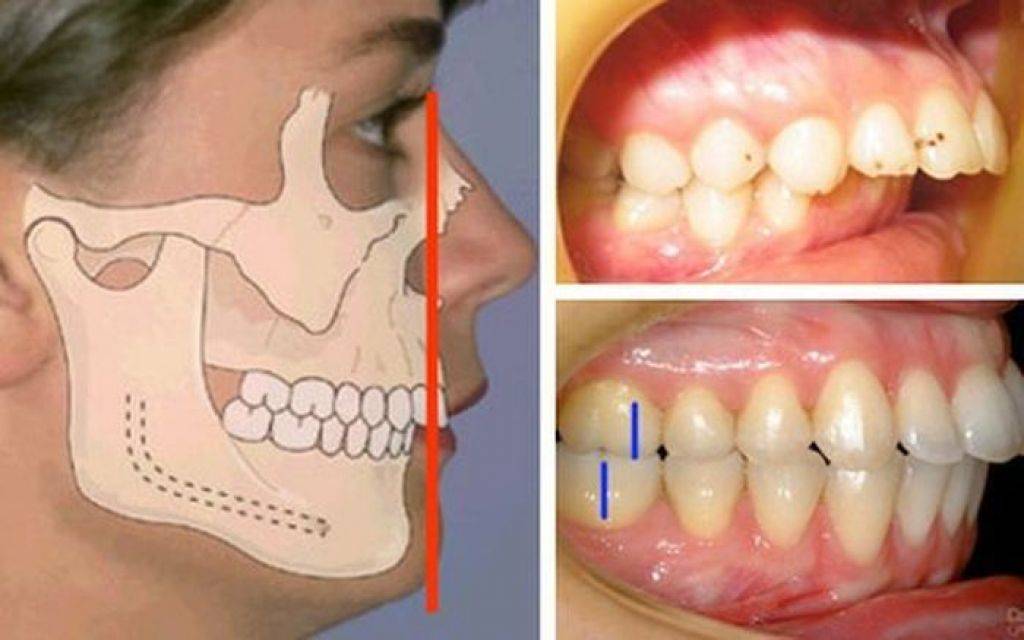 Неправильный прикус: причины, последствия, способы исправления | центр стоматологии «ваш стоматолог»