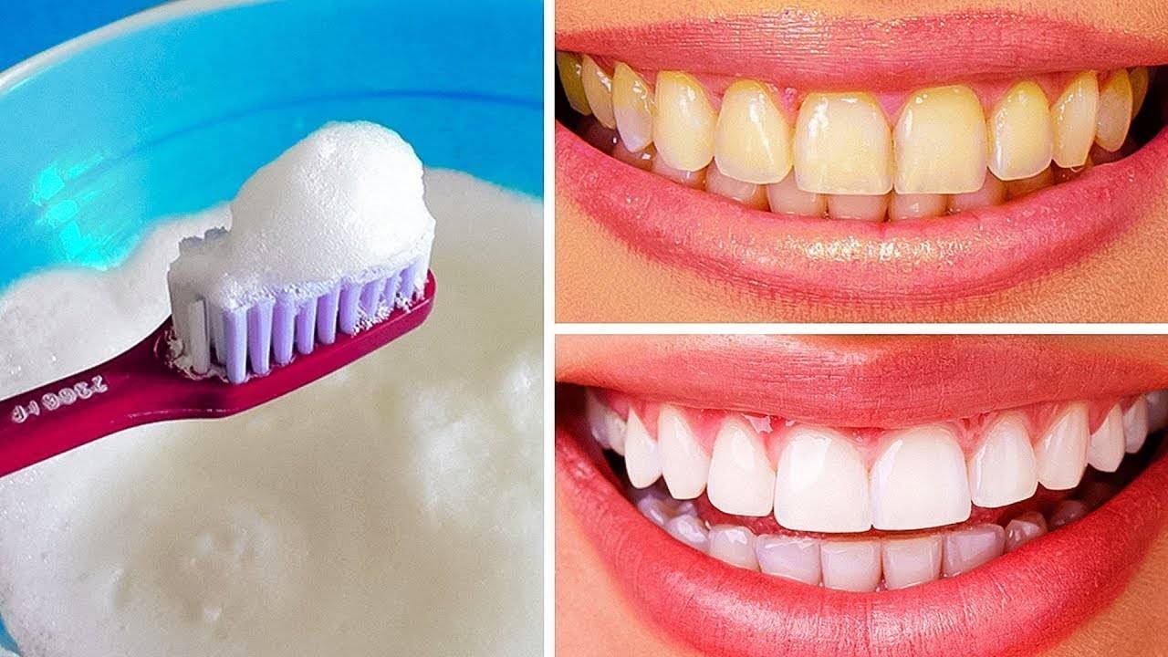Отбеливание зубов в домашних условиях: 25 лучших и эффективных методов | стомвз.рф