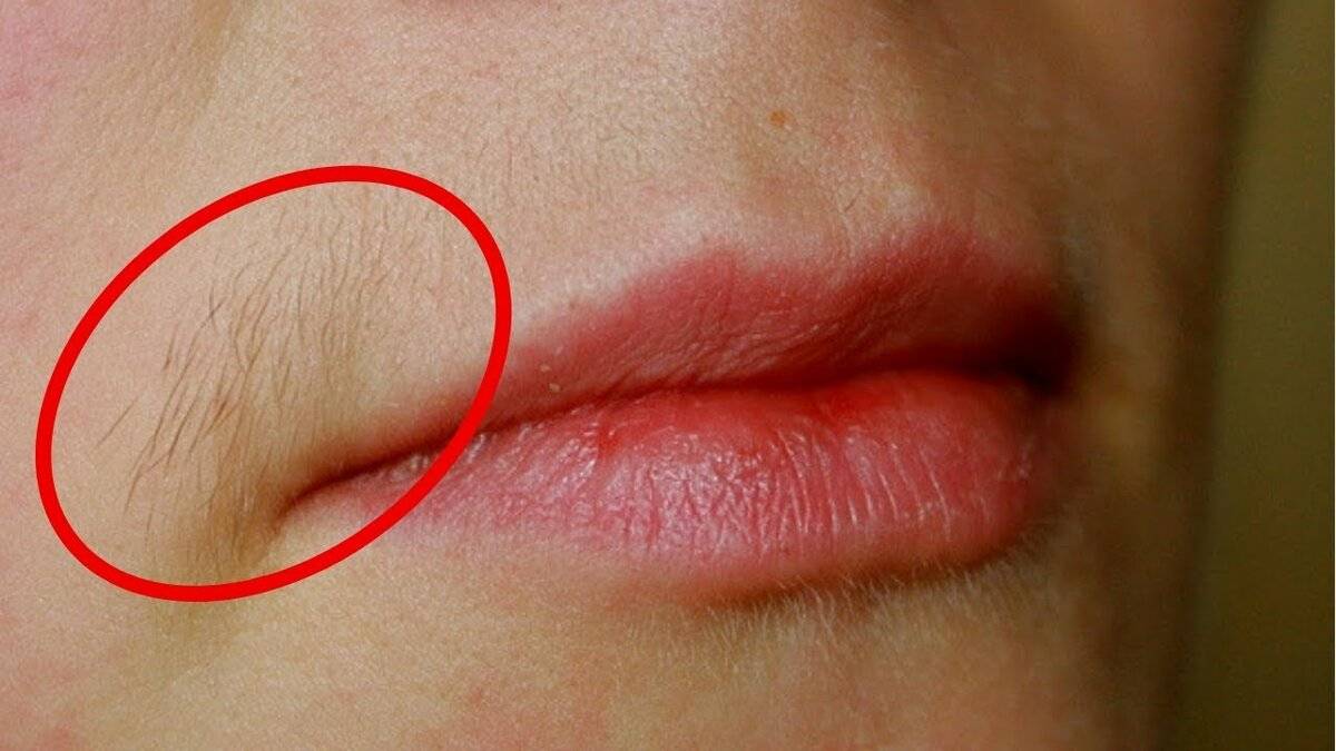 Сыпь на губах: причины возникновения, диагностика, лечение, сыпь на губах у ребенка, беременной, чем опасна, куда обратиться
