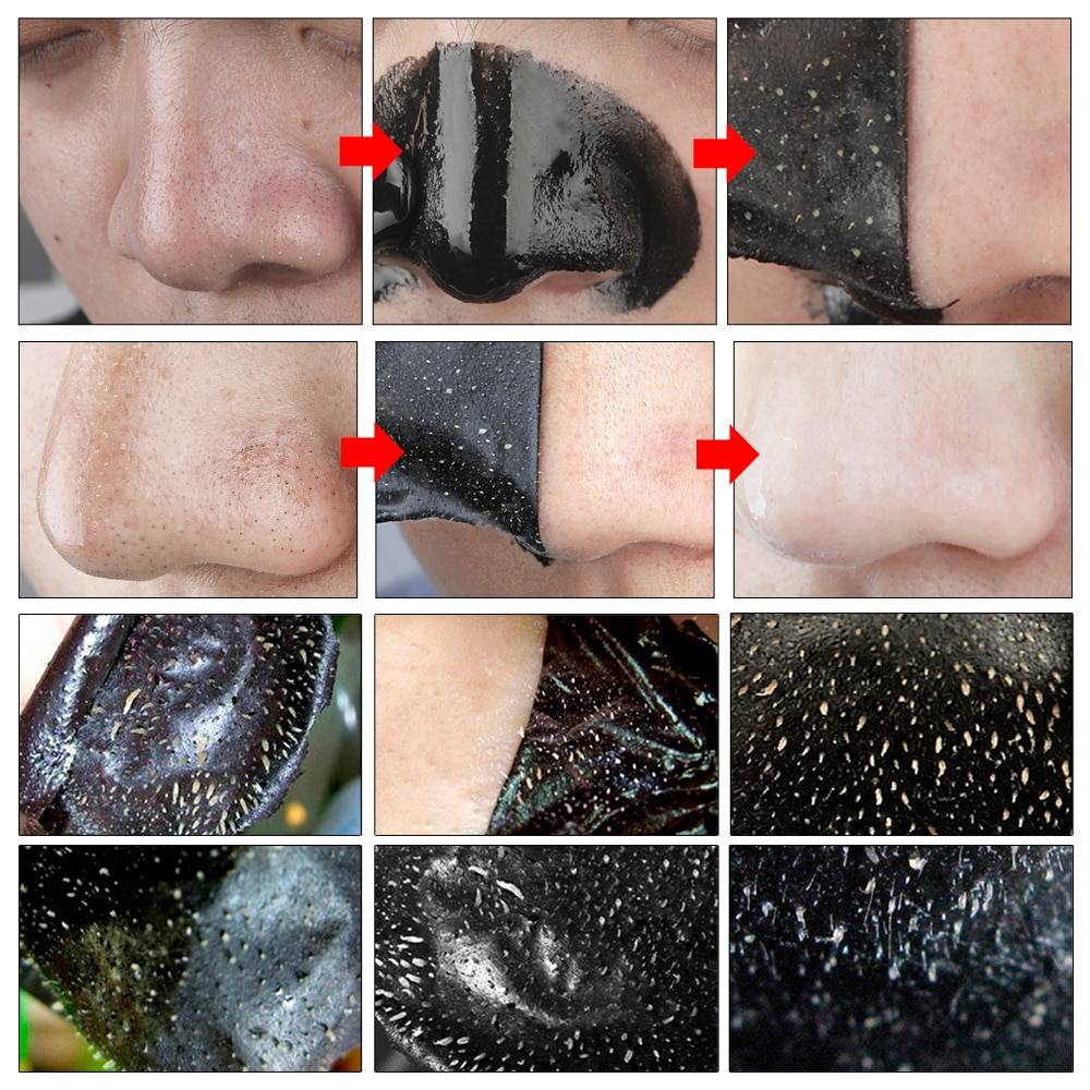 Лицо после механической чистки, противопоказания к ультразвоковой чисте комбинированной кожи лица